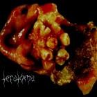 Teratoma - Teratoma